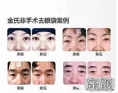 眼袋一旦形成能消除吗
